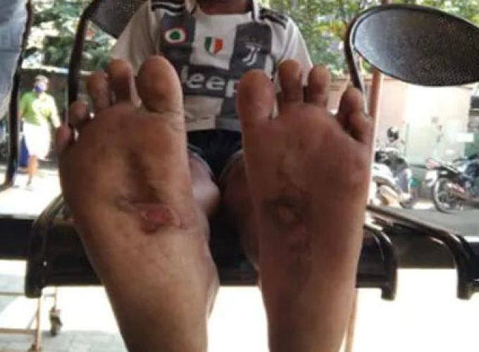 five year old boys foot brutally burned by mother case