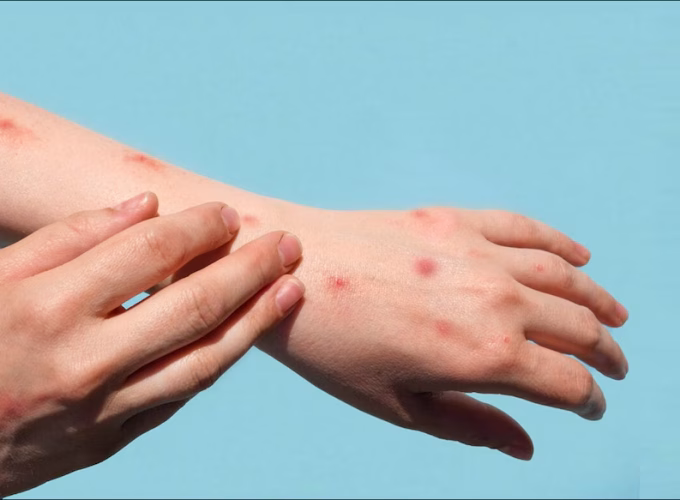 mpox-representational